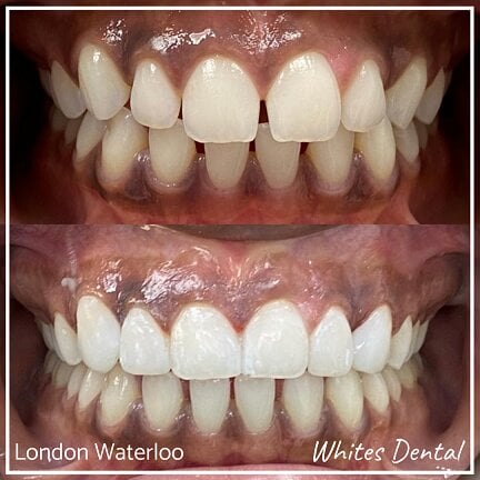 Composite Bonding London Waterloo 3 | Whites Dental