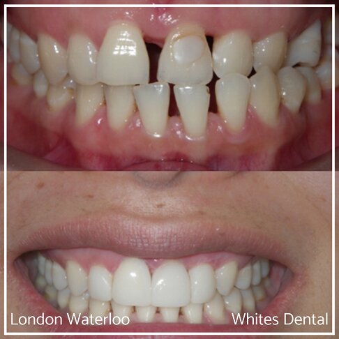 Composite Veneer Before And After - Cosmetic Dentist in London 1