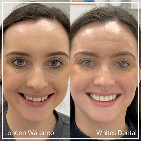 Invisalign Braces Before And After - Orthodontist in London 1