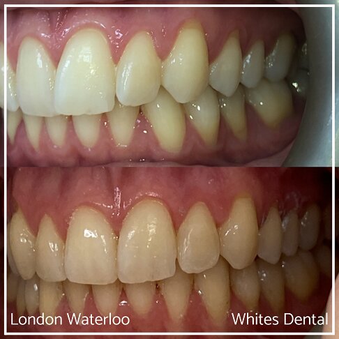 Invisalign Braces Before And After - Orthodontist in London 13