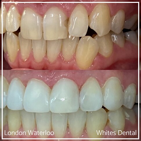 Invisalign Braces Before And After - Orthodontist in London 16