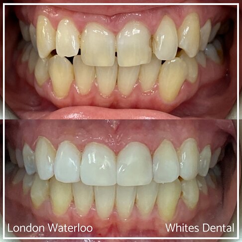Invisalign Braces Before And After - Orthodontist in London 18