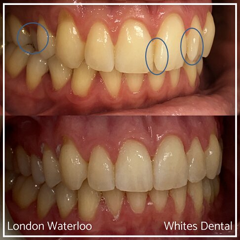 Invisalign Braces Before And After - Orthodontist in London 19