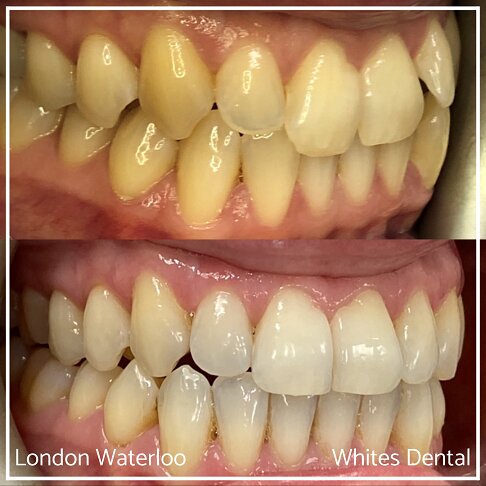 Invisalign Braces Before And After - Orthodontist in London 21