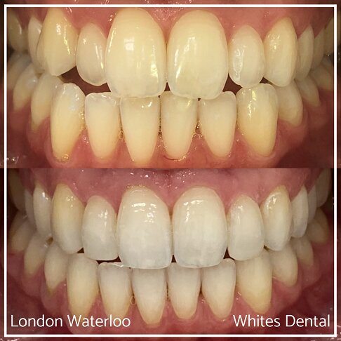 Invisalign Braces Before And After - Orthodontist in London 24