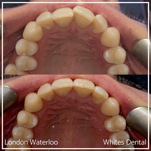 Invisalign Braces Before And After - Orthodontist in London 25