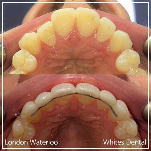 Invisalign Braces Before And After - Orthodontist in London 28