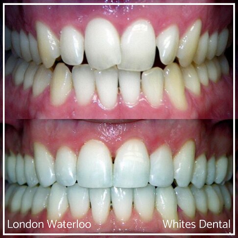 Invisalign Braces Before And After - Orthodontist in London 3
