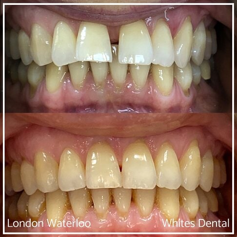 Invisalign Braces Before And After - Orthodontist in London 30