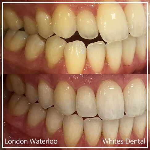 Invisalign Braces Before And After - Orthodontist in London 32