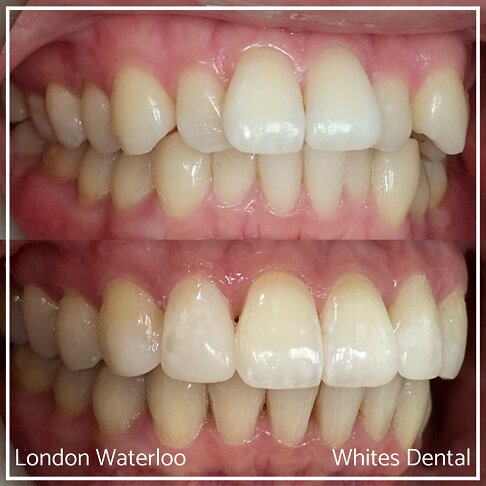 Invisalign Braces Before And After - Orthodontist in London 37