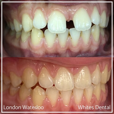 Invisalign Braces Before And After - Orthodontist in London 41