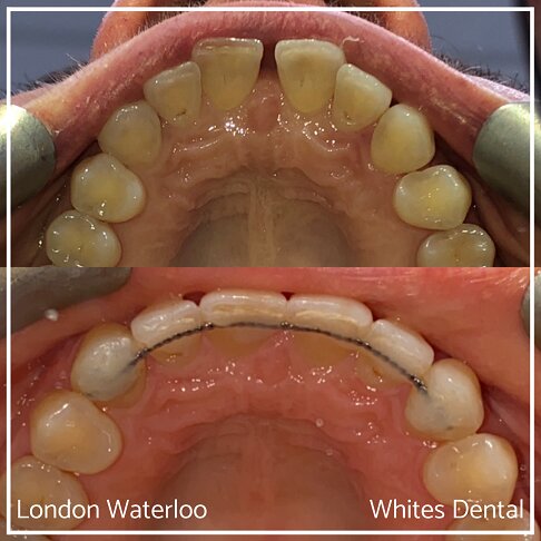 Invisalign Braces Before And After - Orthodontist in London 44
