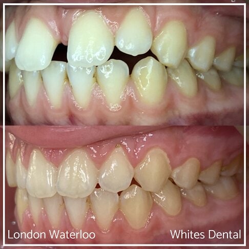 Invisalign Braces Before And After - Orthodontist in London 45