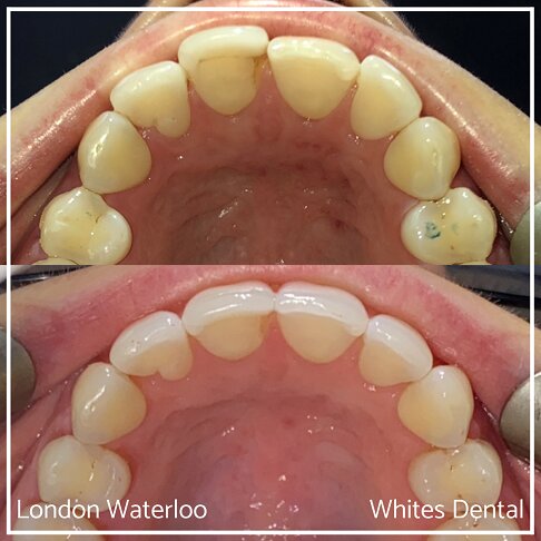 Invisalign Braces Before And After - Orthodontist in London 46
