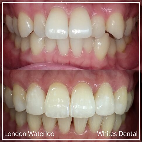 Invisalign Braces Before And After - Orthodontist in London 48