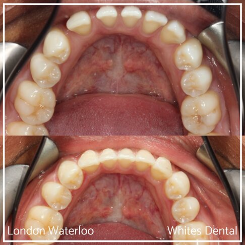 Invisalign Braces Before And After - Orthodontist in London 50