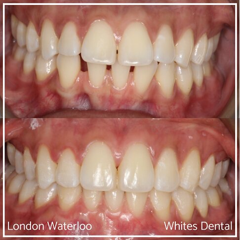 Invisalign Braces Before And After - Orthodontist in London 51
