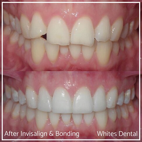 Invisalign Braces Before And After - Orthodontist in London 55