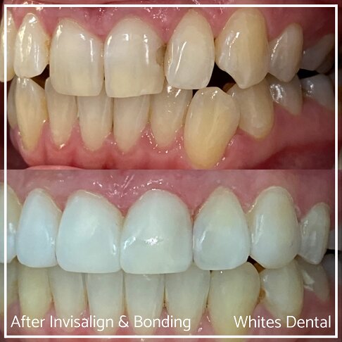 Invisalign Braces Before And After - Orthodontist in London 58