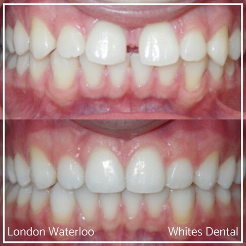 Invisalign Braces Before And After - Orthodontist in London 6