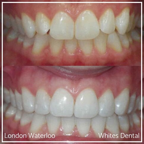 Invisalign Braces Before And After - Orthodontist in London 7