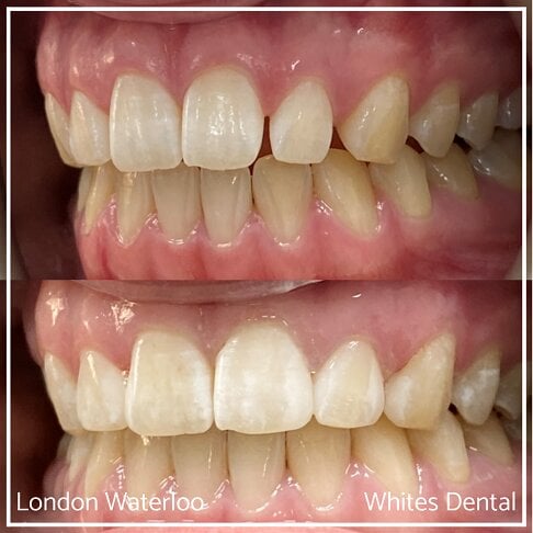 Composite Bonding in London. Whites Dental