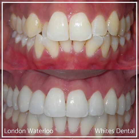 Invisalign Braces in London | Whites Dental