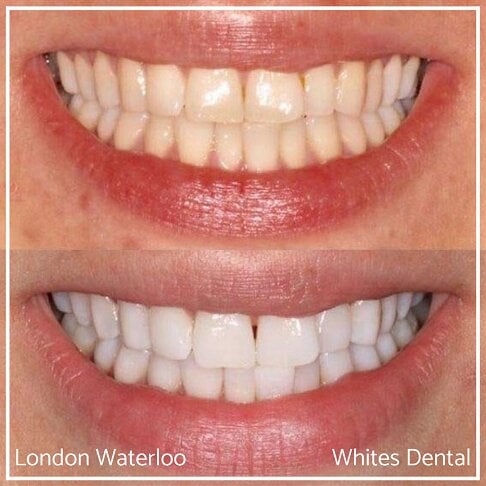 Teeth Whitening in London. Whites Dental