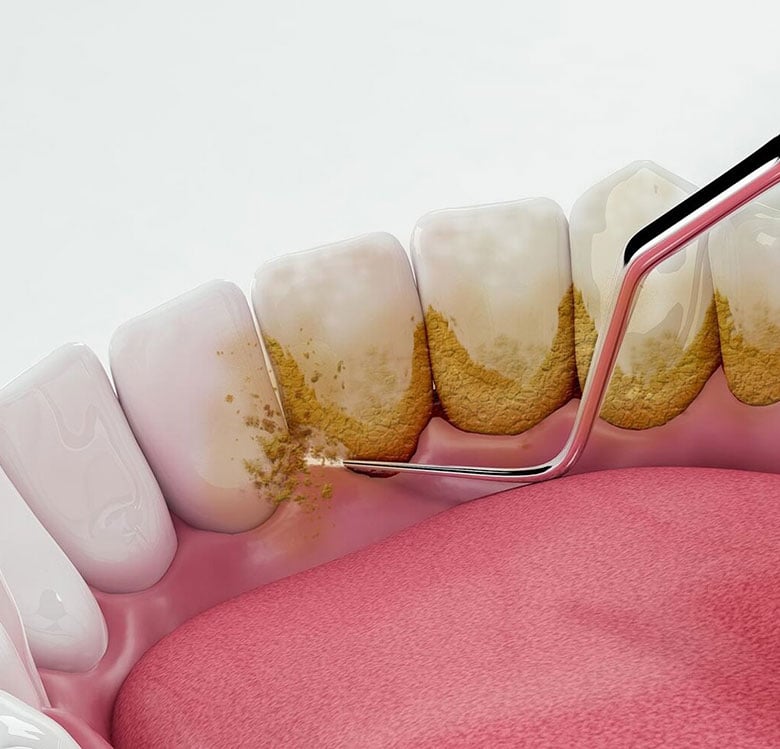 Dental Hygienist London | Whites Dental