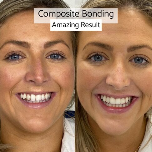 Composite Bonding London – before and after result