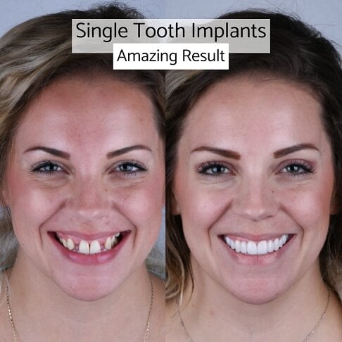 Dental Implants London | Whites Dental