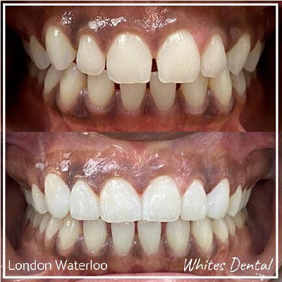 Composite bonding before and after image showing results of a clients composite bonding treatment.