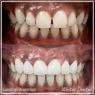 is it worth getting composite bonding | Whites Dental