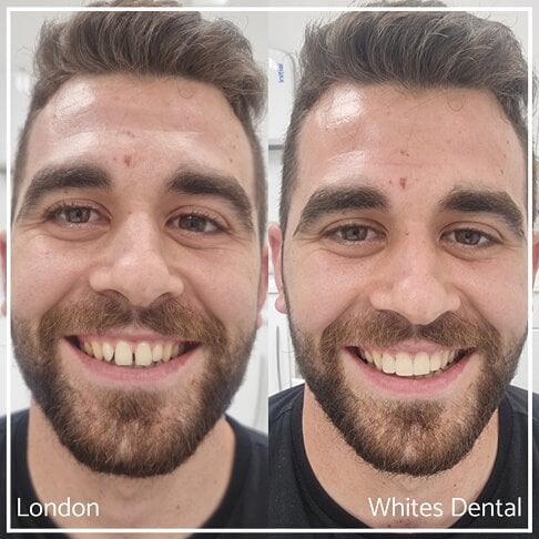 Composite Bonding Before And After Cosmetic Dentist In London 2 | Whites Dental