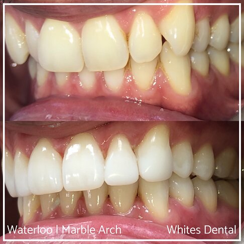 Invisalign Braces Before And After Orthodontist In London 1 | Whites Dental