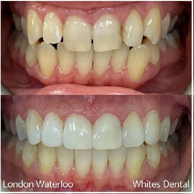 Is Invisalign Cheaper Than Braces Invisalign in London | Whites Dental