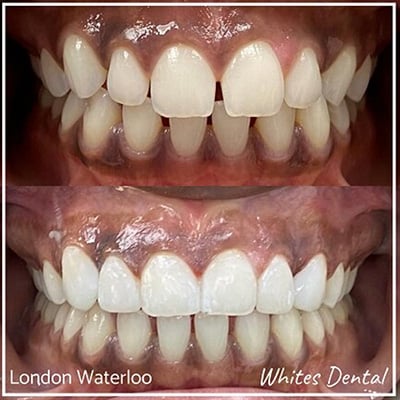 Composite bonding before and after examples of customers teeth.