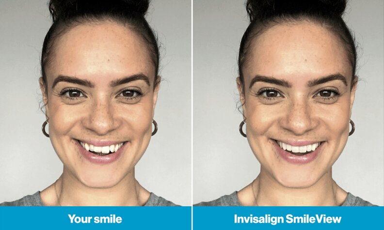 Invisalign Before And After SmileSimulation | Whites Dental