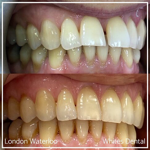 Invisalign Braces Before And After Orthodontist in London 1 Gap | Whites Dental