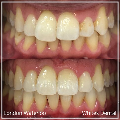 Invisalign Braces Before And After Orthodontist in London 1 Overbite Underbite | Whites Dental