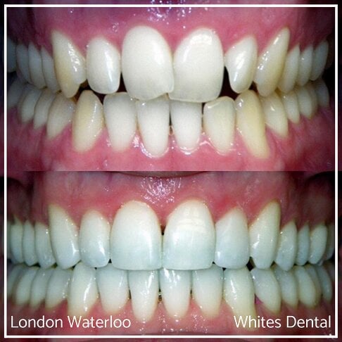 Invisalign Braces Before And After Orthodontist in London 1 Overcrowding | Whites Dental