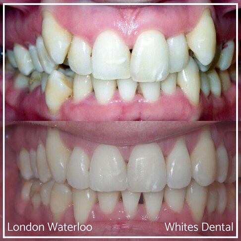 Invisalign Braces Before And After Orthodontist in London 1 Worst Cases | Whites Dental