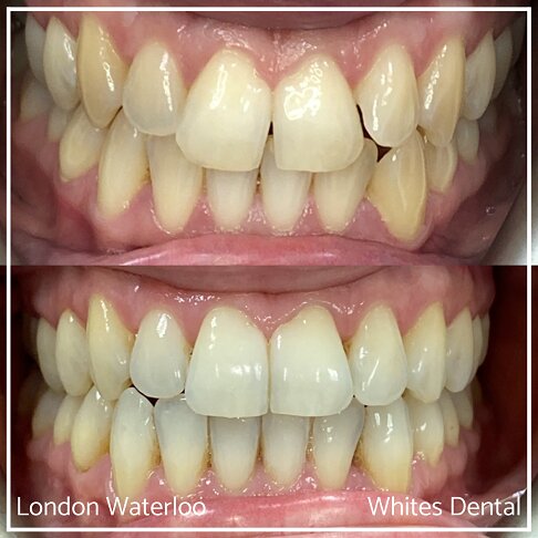 Invisalign Braces Before And After Orthodontist in London 10 Overcrowding | Whites Dental