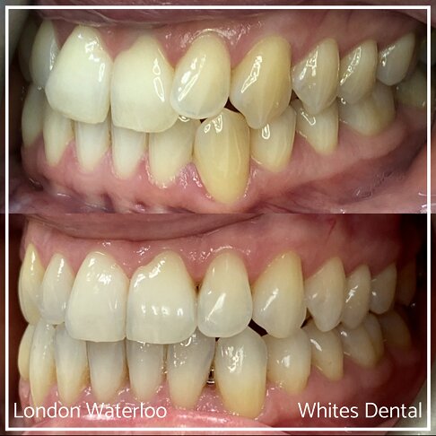 Invisalign Braces Before And After Orthodontist in London 11 Overcrowding | Whites Dental