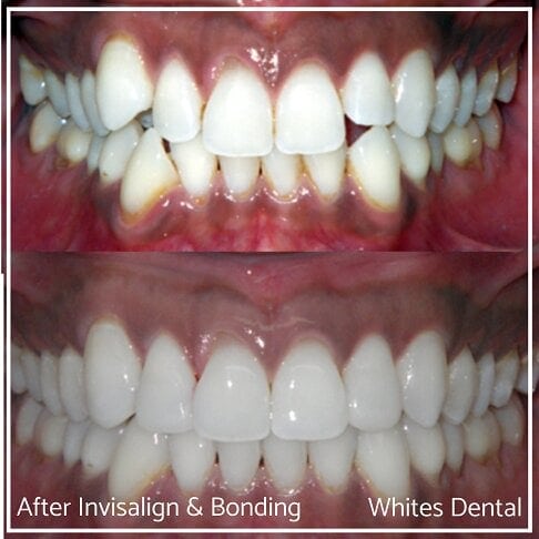 Invisalign Braces Before And After Orthodontist in London 13 Worst Cases | Whites Dental