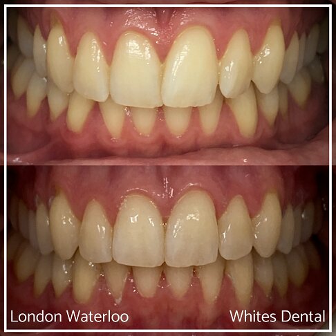 Invisalign Braces Before And After Orthodontist in London 14 Overcrowding | Whites Dental