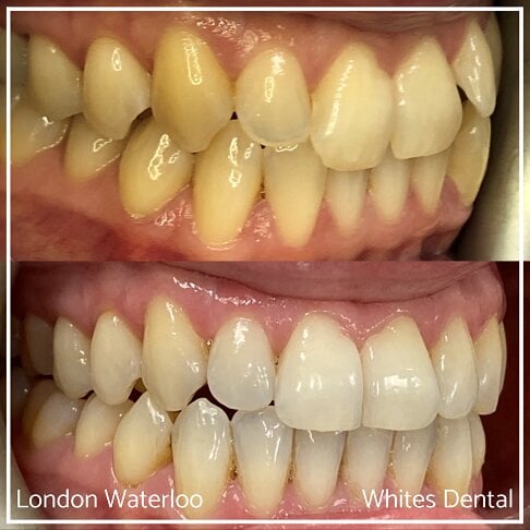 Invisalign Braces Before And After Orthodontist in London 14 Worst Cases | Whites Dental