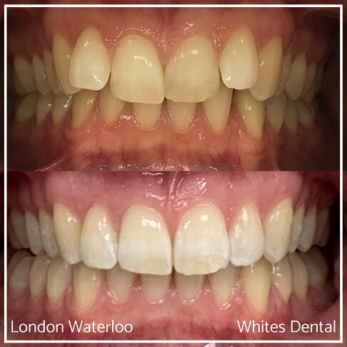 Invisalign Braces Before And After Orthodontist in London 15 Worst Cases | Whites Dental