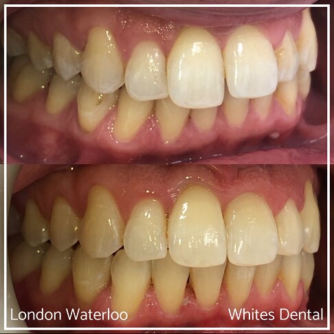Invisalign Braces Before And After Orthodontist in London 16 Overcrowding | Whites Dental